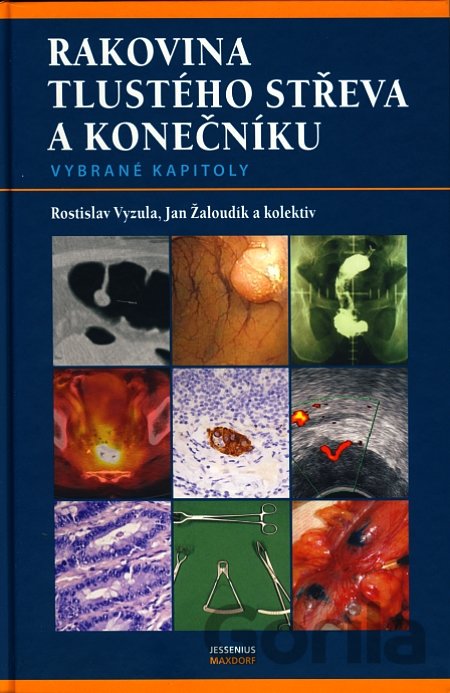 Kniha Rakovina tlustého střeva a konečníku - Rostislav Vyzula, Jan Žaloudík