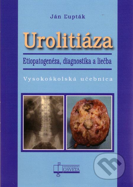 Urolitiáza - Ján Ľupták