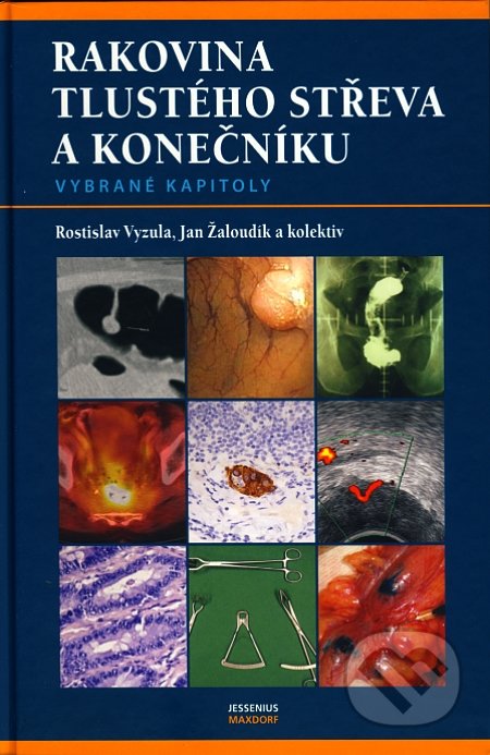 Rakovina tlustého střeva a konečníku - Rostislav Vyzula, Jan Žaloudík